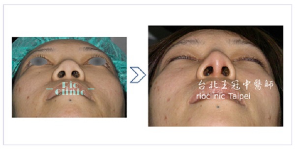 縮鼻手術,縮鼻翼(鼻翼縮小)、縮鼻孔:鼻頭變尖、鼻珠拉出而鼻孔朝天改善。