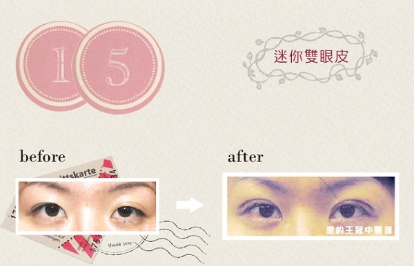 台北雙眼皮推薦-迷你雙眼皮比對照15