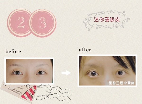 台北雙眼皮推薦-迷你雙眼皮比對照23