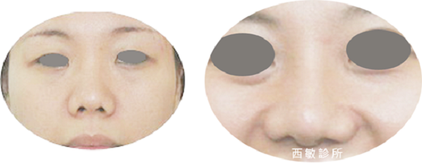 台北隆鼻精確的Goretex隆鼻+鼻頭整形手術  (台北隆鼻手術推薦：王冠中醫師)