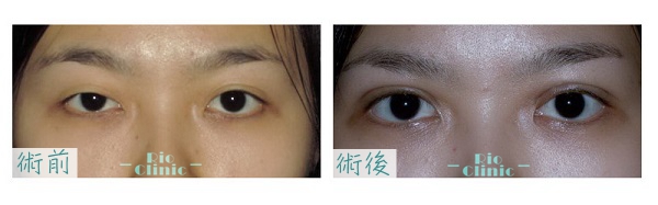 割雙眼皮手術矯正大小眼，變成大大放電眼 (台北割雙眼皮)