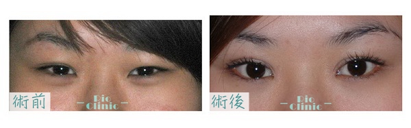 台北割雙眼皮 案例4