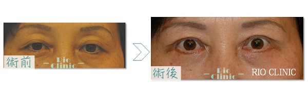台北割雙眼皮 案例10 (里約整形外科診所)