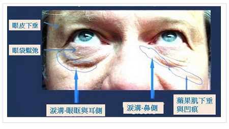 眼袋手術,老化眼袋的外表