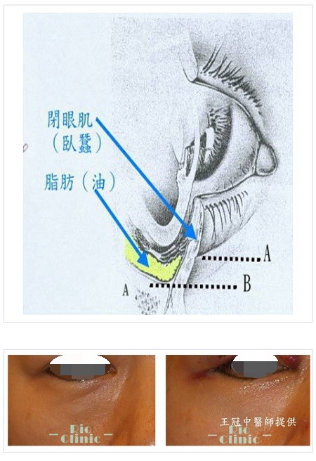  眼袋手術,第一期的眼袋