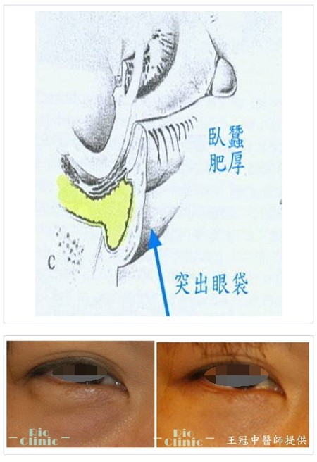 眼袋手術,第三期的眼袋