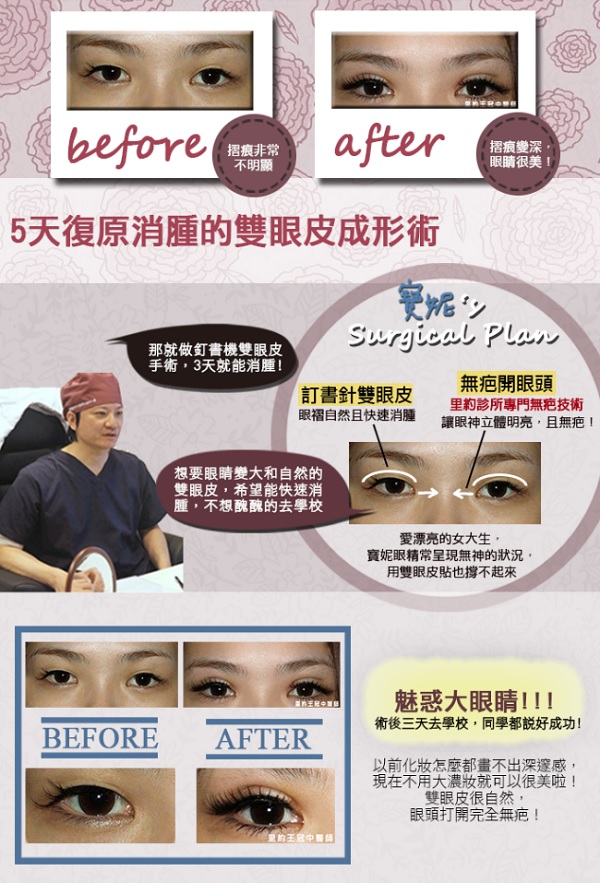 韓式雙眼皮-訂書針縫雙眼皮+無疤開眼頭手術前後比較圖