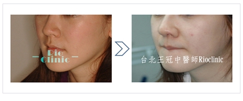 縮鼻頭手術,簡單硬G鼻也會讓鼻子有混血兒FU