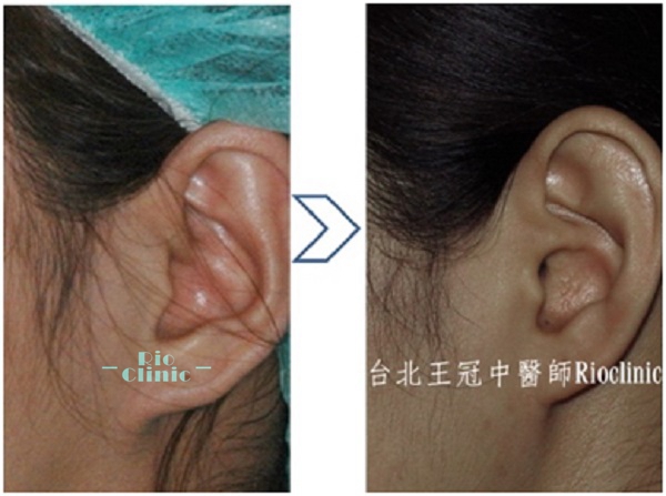 耳軟骨移植 (台北隆鼻手術推薦：王冠中醫師)