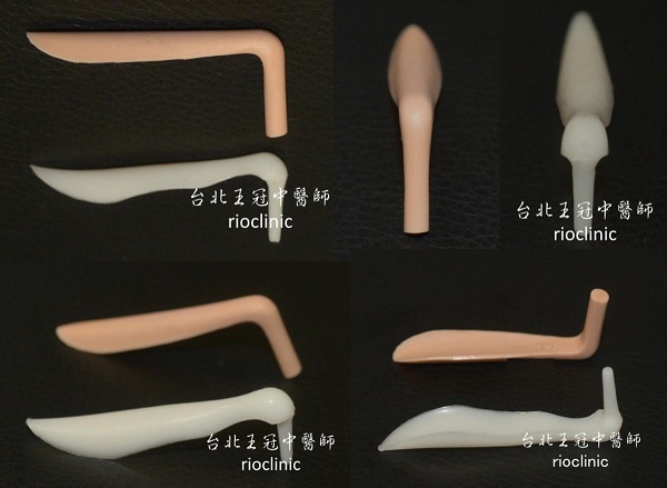 矽膠鼻骨比較：白色是韓國鼻骨，明顯可見鼻頭較圓、側面流線形、底座波浪狀、L形的短臂變細變短。