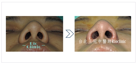 縮鼻頭手術,縮鼻頭,縮鼻手術,鼻孔縮小手術,縮鼻翼手術,台北王冠中醫師