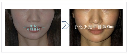 縮鼻頭案例4：鼻頭，耳軟骨移植,台北王冠中醫師