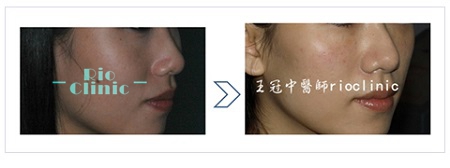 縮鼻頭,硬G鼻樑（Goretex）+ 耳軟骨移植,里約王冠中醫師