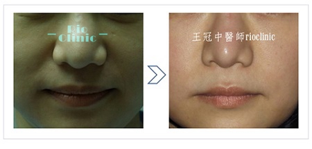 矽膠鼻頭改為自體軟骨，原本發炎肥厚的鼻頭自然縮小。鼻孔縮小手術,縮鼻手術,里約王冠中醫師