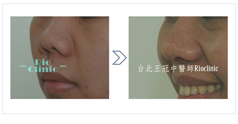  縮鼻頭手術案例8：朝天鼻+退縮鼻,里約王冠中醫師