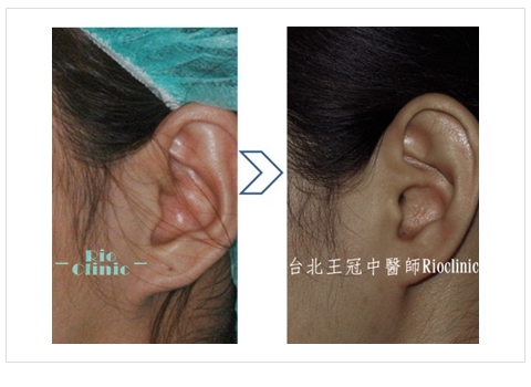 耳軟骨移植-縮鼻頭手術