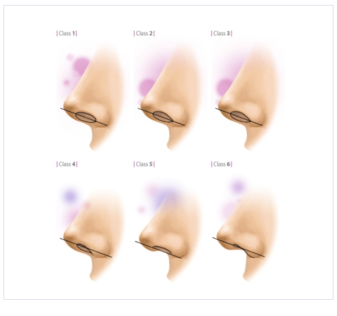 鼻頭與鼻孔的關係(縮鼻頭手術)