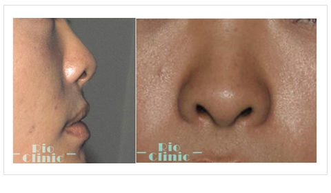 鼻孔外露，俗稱「朝天鼻」(縮鼻頭手術)