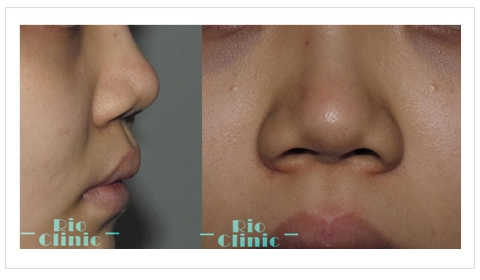 縮鼻頭手術,解決的方法：硬式Ｇoretex隆鼻或縮鼻翼