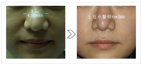 縮鼻頭手術,矽膠鼻頭改為自體軟骨，原本發炎肥厚的鼻頭自然縮小