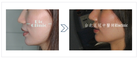 鼻頭手術:提高鼻頭同時避免朝天，形成混血兒似的美麗側面線條